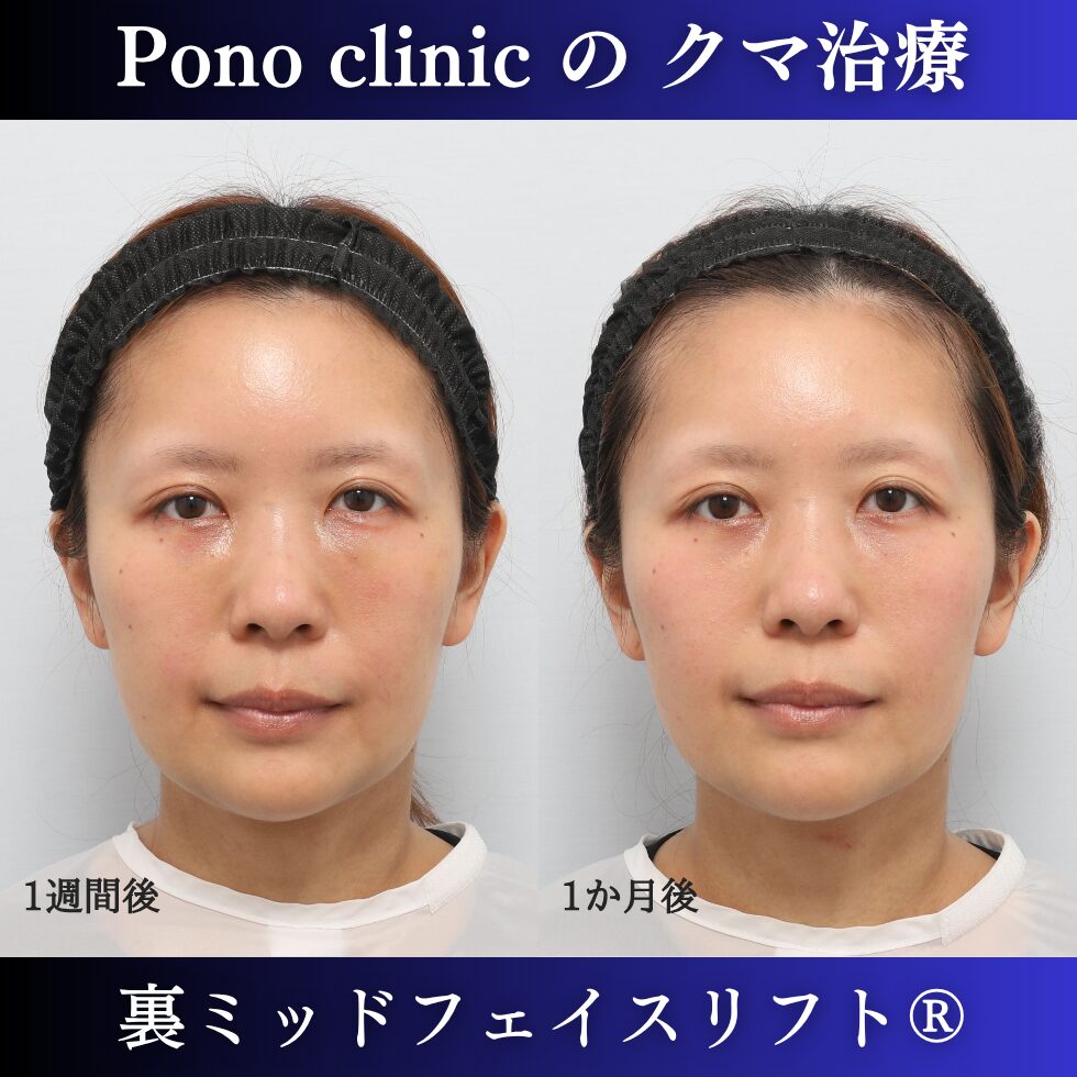 30代女性の裏ミッドフェイスリフト術後1週間・術後1か月の経過比較