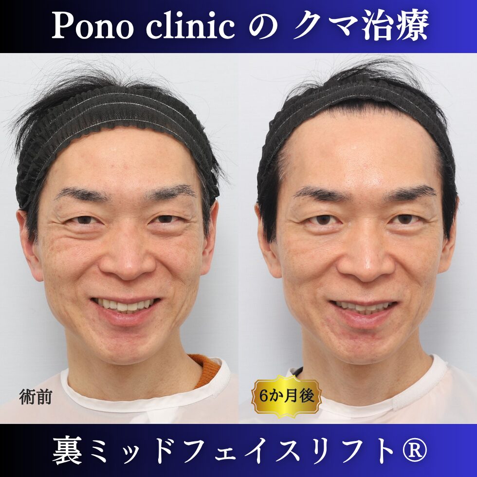 40代男性の裏ミッドフェイスリフト術前と術後6か月の笑顔比較