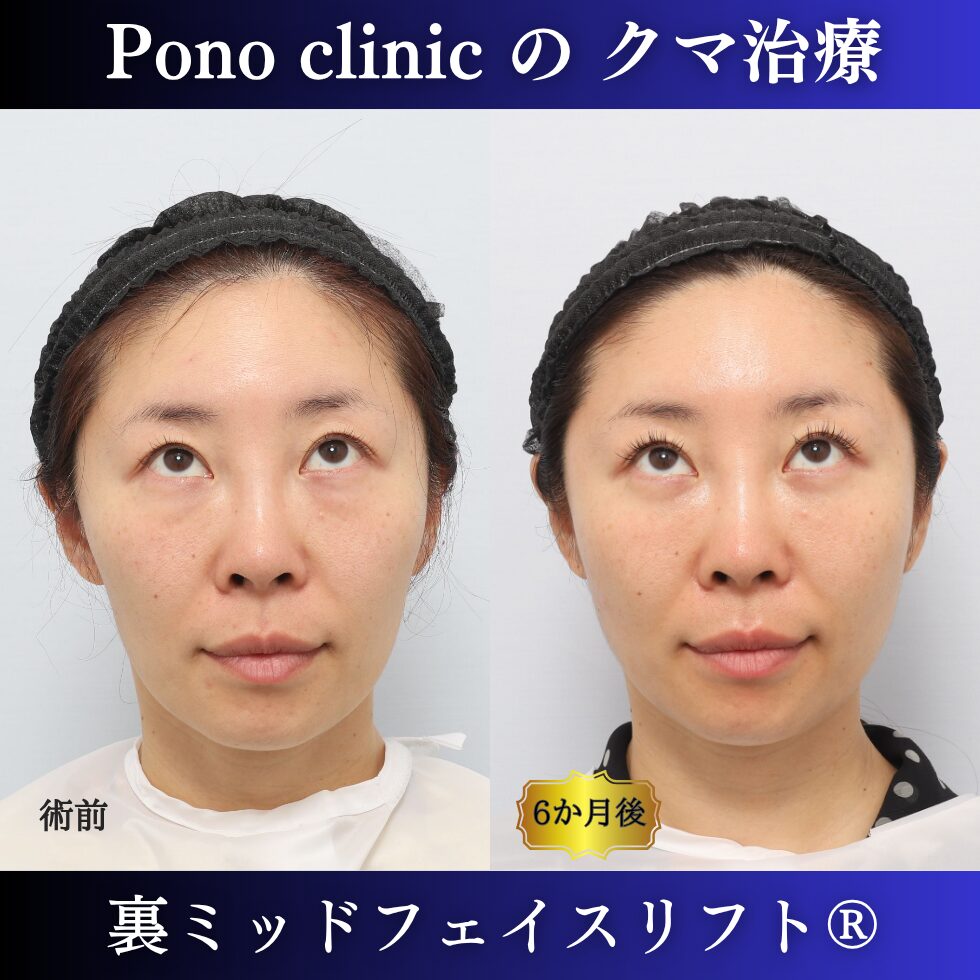 目の下のクマ、クマ治療、裏ハムラ、骨膜下リフト、裏ミッドフェイスリフト、30代の症例 (4)