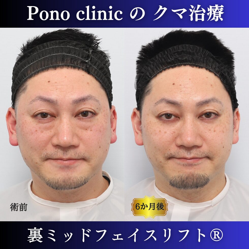40代男性の裏ミッドフェイスリフト術前・術後の笑顔比較