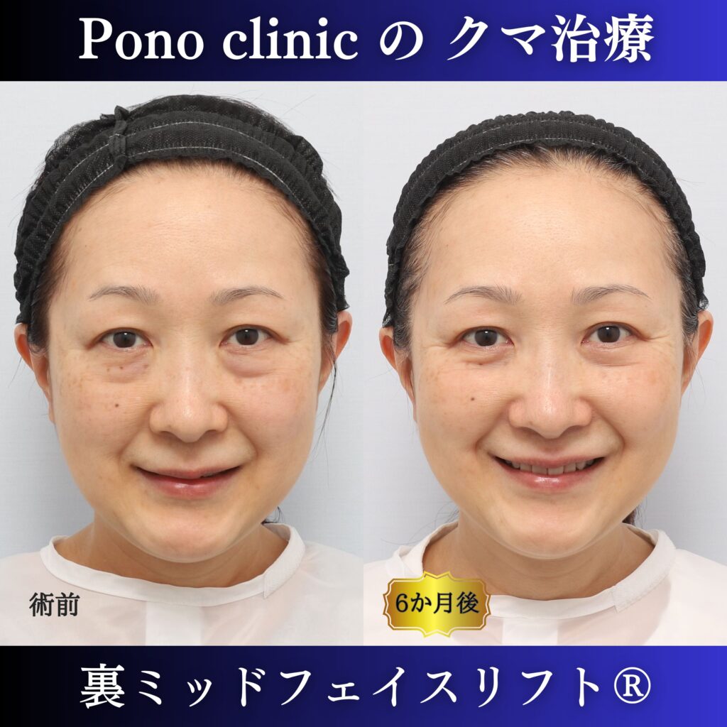 50代女性の裏ミッドフェイスリフト笑顔・術後6か月比較