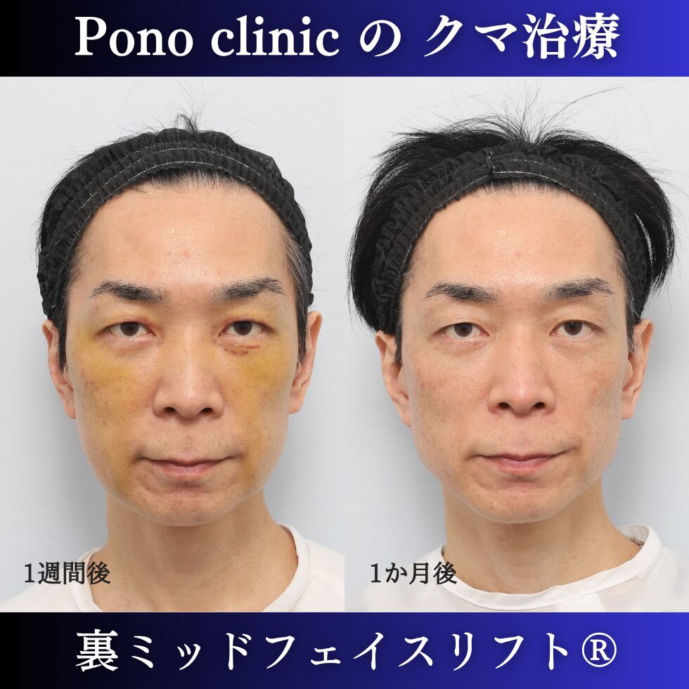 40代男性の裏ミッドフェイスリフト術後1週間と術後1か月の経過比較