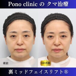 クマ治療、裏ハムラ、骨膜下リフト、ミッドフェイスリフト、裏ミッドフェイスリフト、40代の症例 (7)