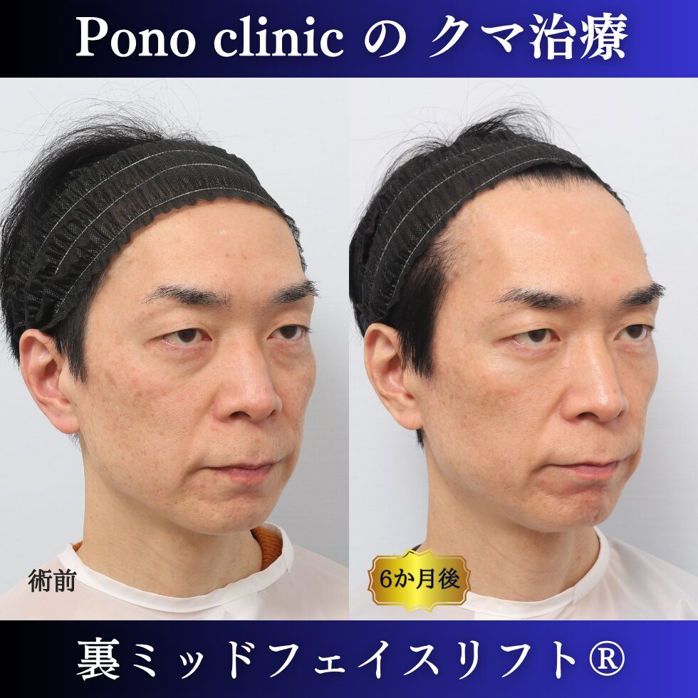 40代男性の裏ミッドフェイスリフト術前と術後6か月の右斜位比較