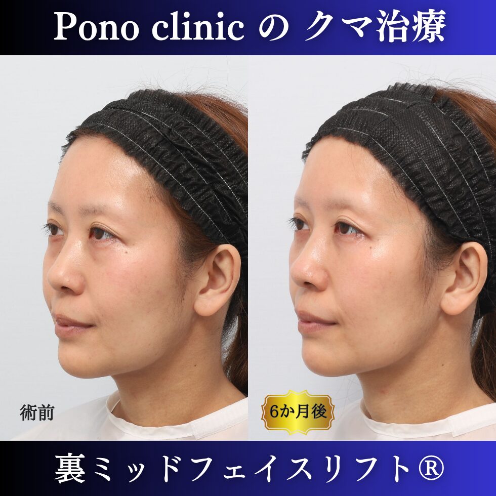 30代女性の裏ミッドフェイスリフト術前・術後の左斜位比較