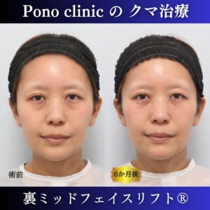 クマ治療、裏ハムラ法、骨膜下リフト、ミッドフェイスリフト、30代の症例 (9)
