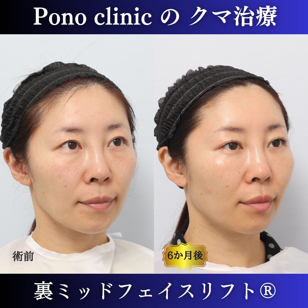 目の下のクマ、クマ治療、裏ハムラ、骨膜下リフト、裏ミッドフェイスリフト、30代の症例 (2)