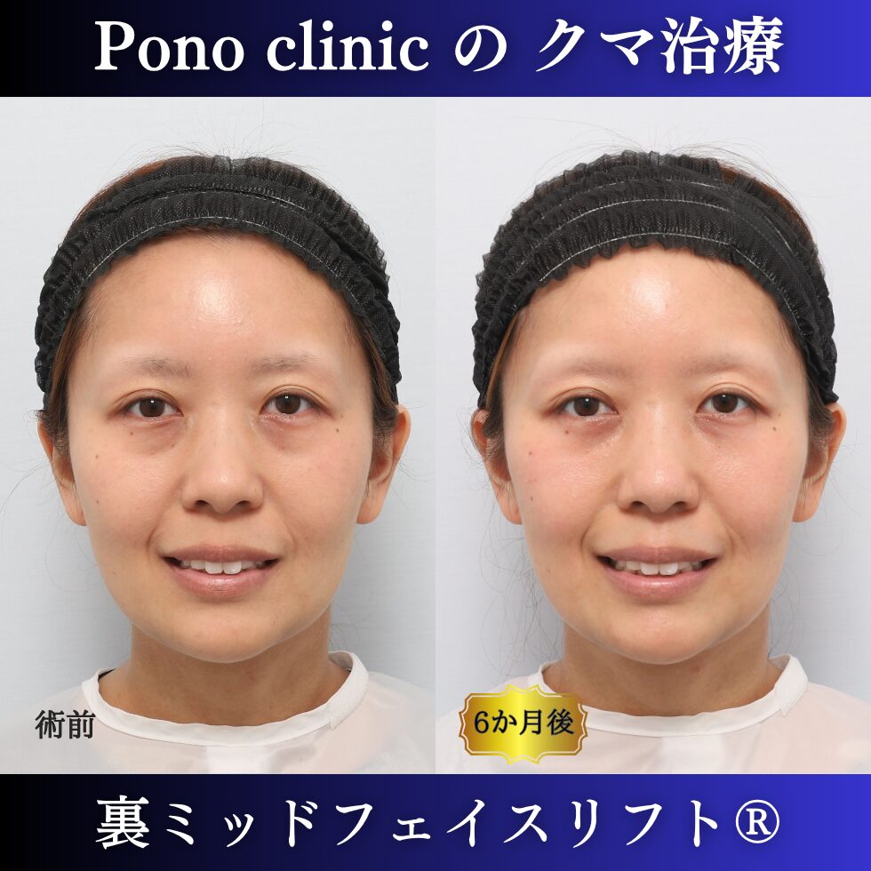 30代女性の裏ミッドフェイスリフト術前・術後の笑顔比較