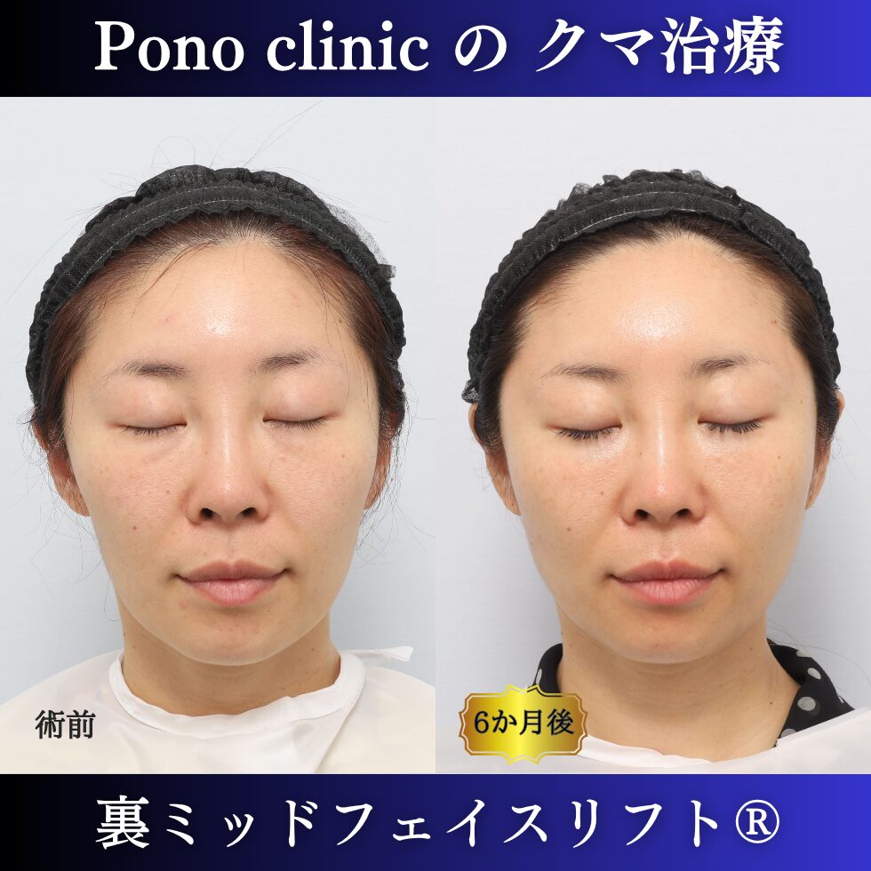 目の下のクマ、クマ治療、裏ハムラ、骨膜下リフト、裏ミッドフェイスリフト、30代の症例 (7)