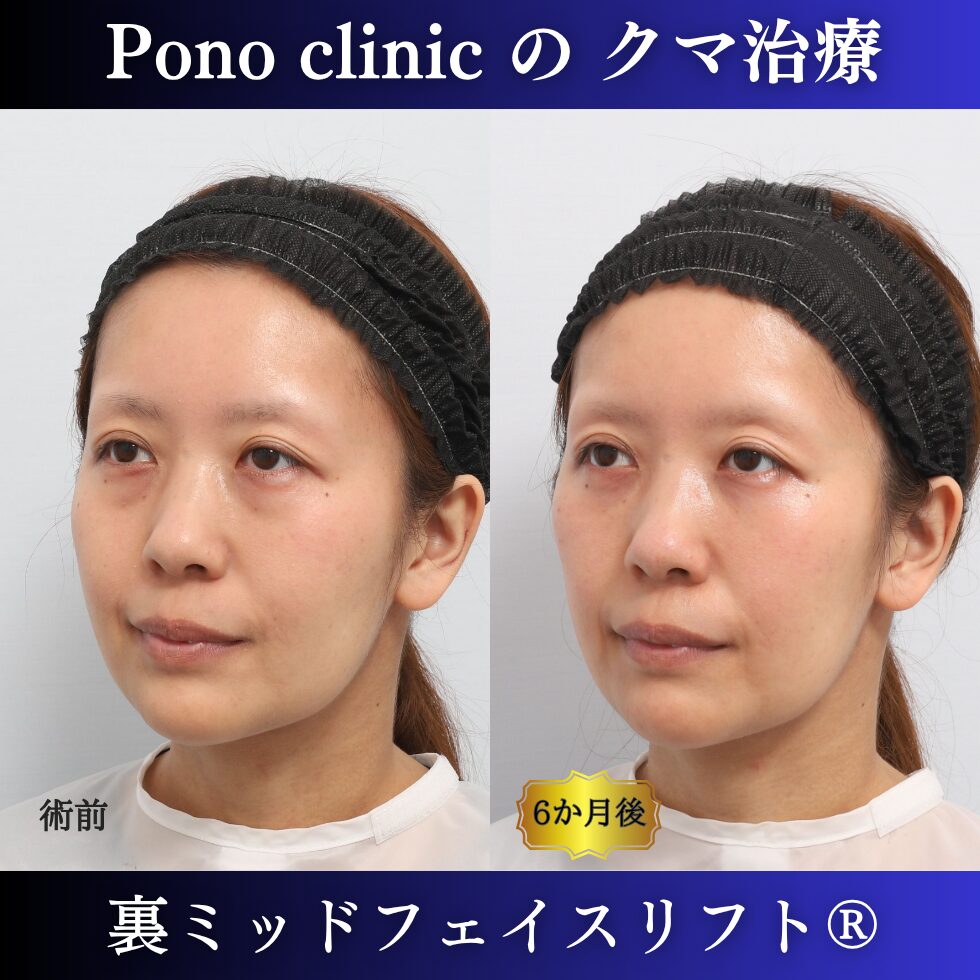 30代女性の裏ミッドフェイスリフト術前・術後の左斜位比較