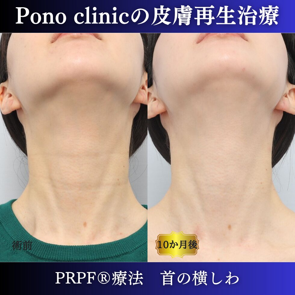 しわ治療、首のしわ、PRPF療法、30代の症例 (5)
