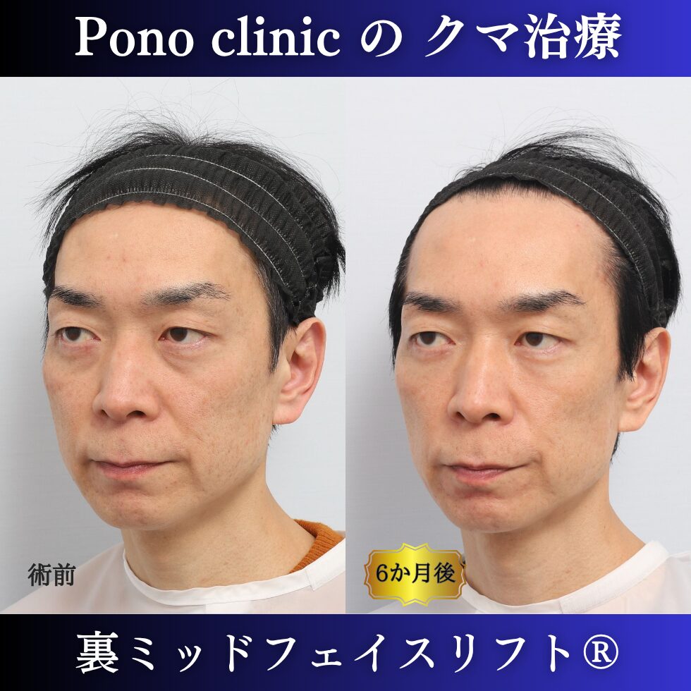 40代男性の裏ミッドフェイスリフト術前と術後6か月の左斜位比較