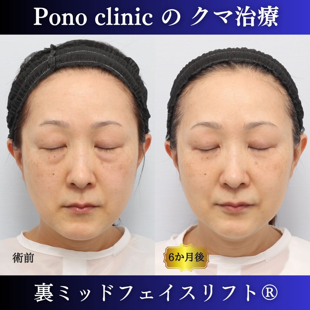 50代女性の裏ミッドフェイスリフト閉眼・術後6か月比較