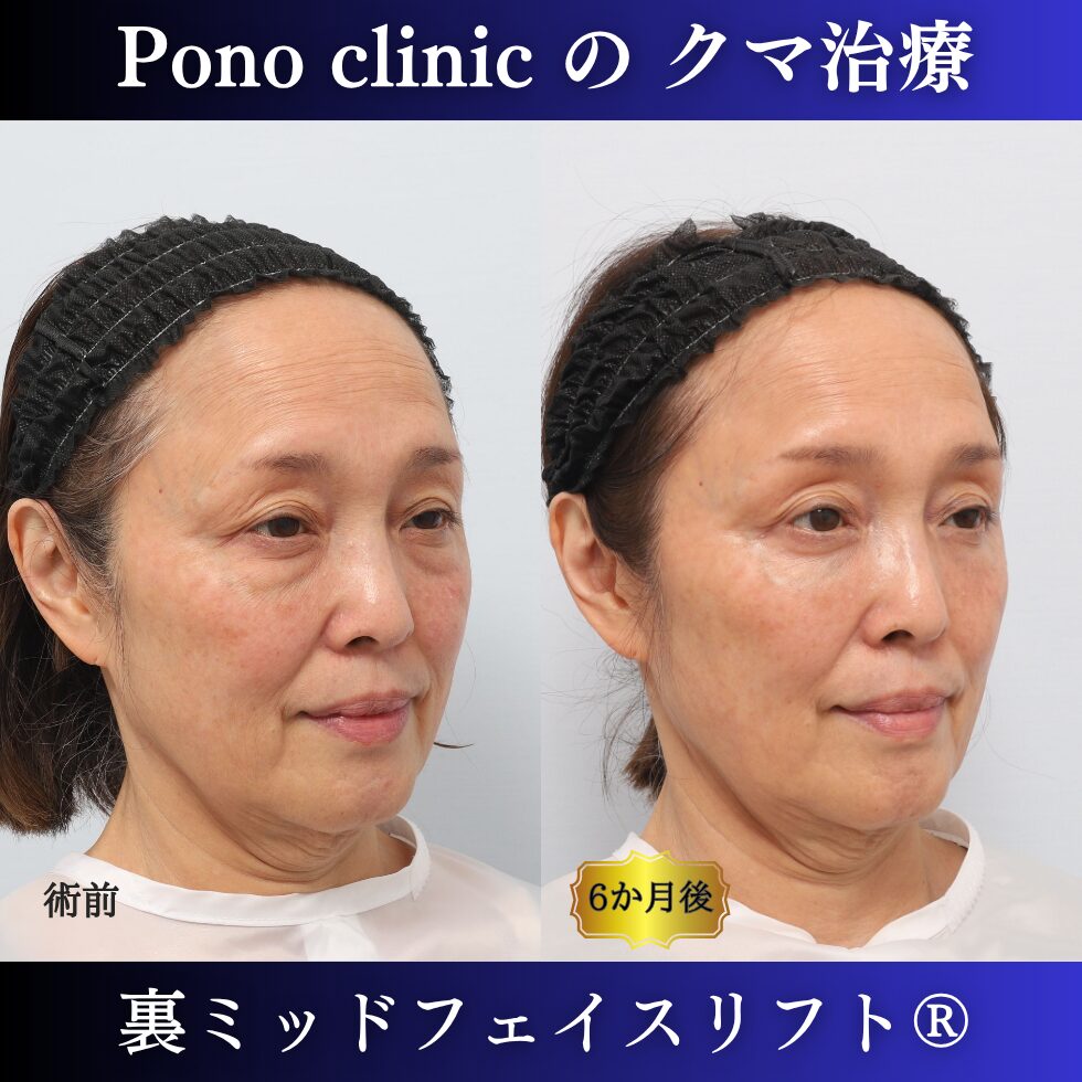 目の下のクマ、目の下のたるみ、裏ハムラ、骨膜下リフト、裏ミッドフェイスリフト、60代の症例 (2)