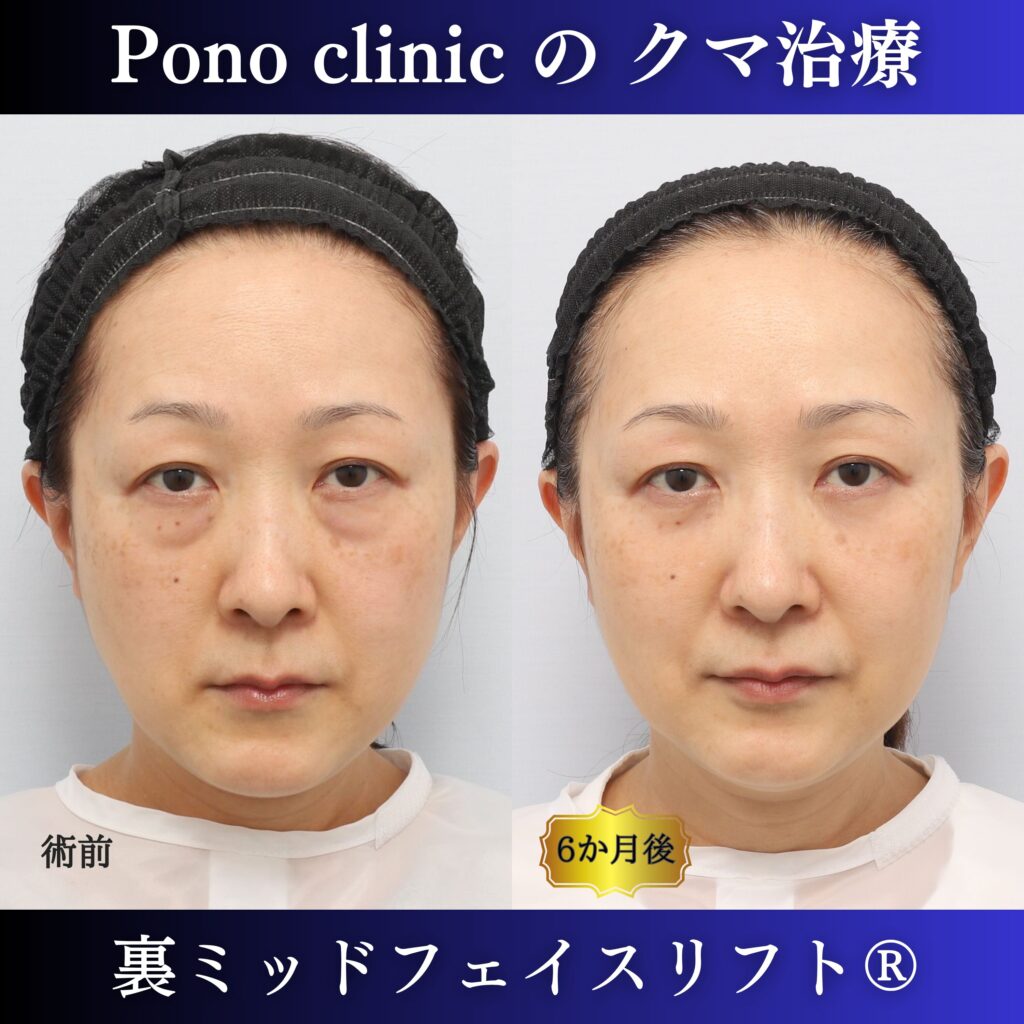 裏ミッドフェイスリフト、ミッドフェイスリフト、骨膜下リフト、裏ハムラ、50代の症例 (7)