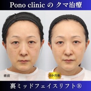 裏ミッドフェイスリフト、ミッドフェイスリフト、骨膜下リフト、裏ハムラ、50代の症例 (7)
