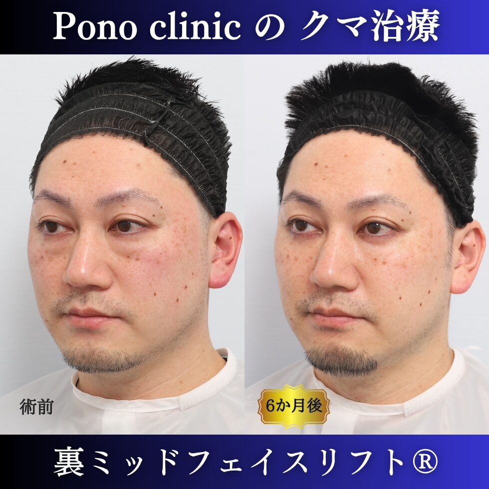 40代男性の裏ミッドフェイスリフト術前・術後の左斜位比較