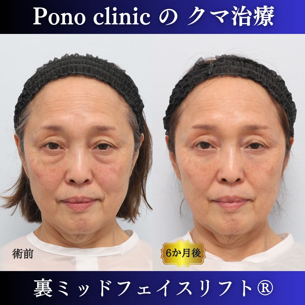 目の下のクマ、目の下のたるみ、裏ハムラ、骨膜下リフト、裏ミッドフェイスリフト、60代の症例 (7)