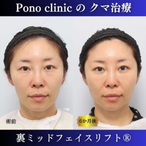 目の下のクマ、クマ治療、裏ハムラ、骨膜下リフト、裏ミッドフェイスリフト、30代の症例 (6)