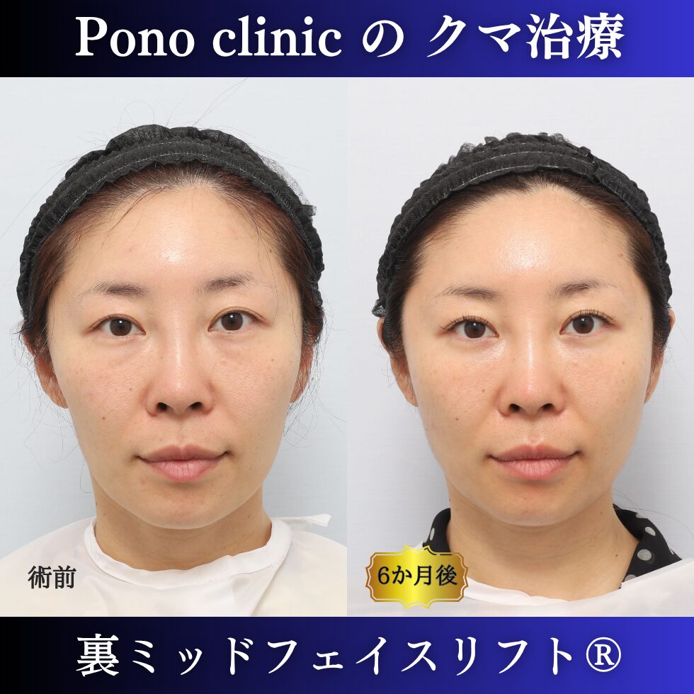 目の下のクマ、クマ治療、裏ハムラ、骨膜下リフト、裏ミッドフェイスリフト、30代の症例 (6)