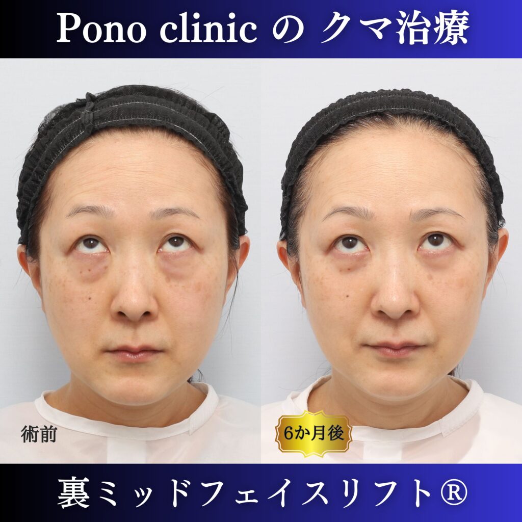 50代女性の裏ミッドフェイスリフト上方視・術後6か月比較