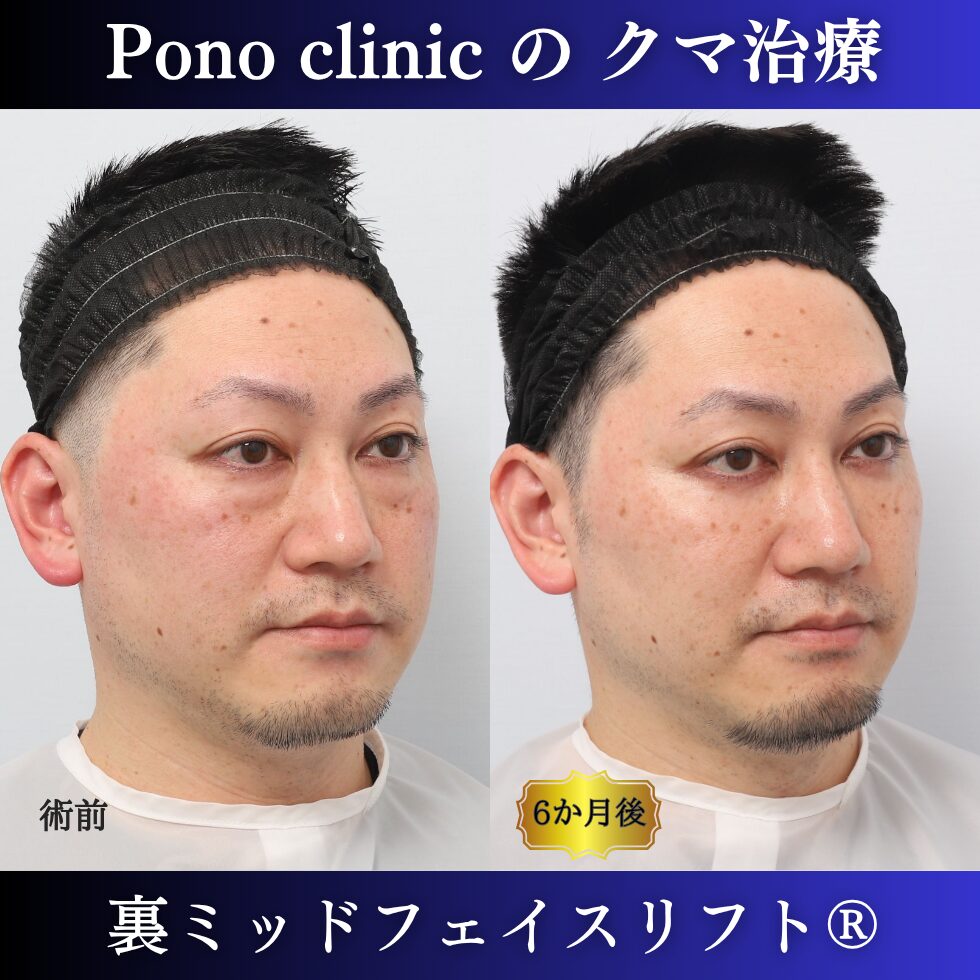 40代男性の裏ミッドフェイスリフト術前・術後の右斜位比較
