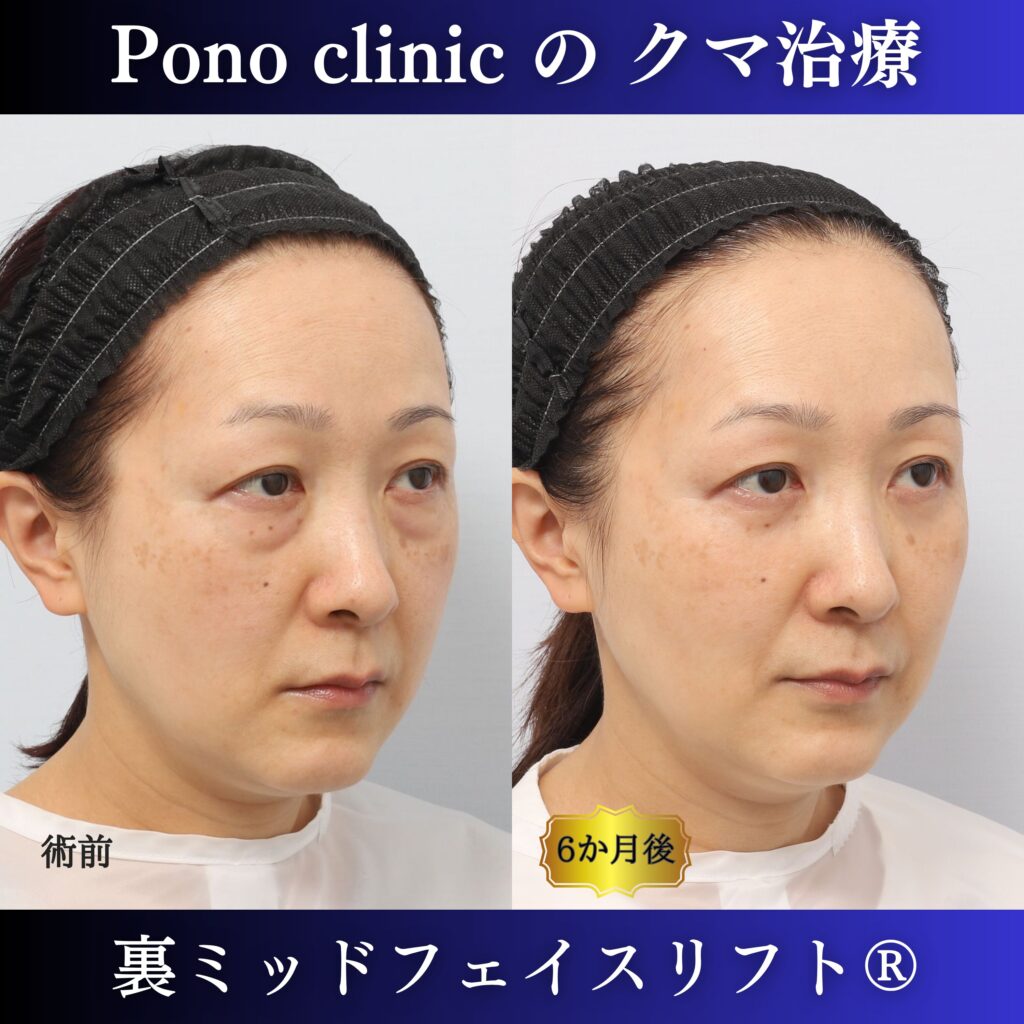50代女性の裏ミッドフェイスリフト右斜位・術後6か月比較