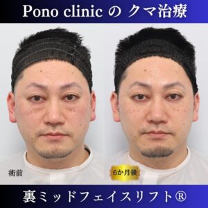 クマ治療、裏ハムラ法、骨膜下リフト、ミッドフェイスリフト、40代男性の症例 (7)