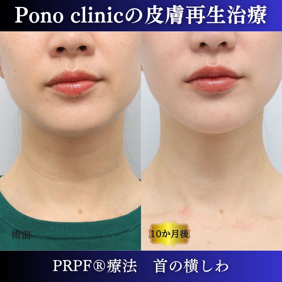 しわ治療、首のしわ、PRPF療法、30代の症例 (6)