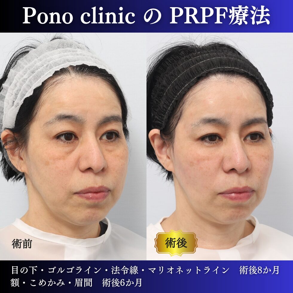 50代女性のPRPF®療法右斜位・治療前治療後比較