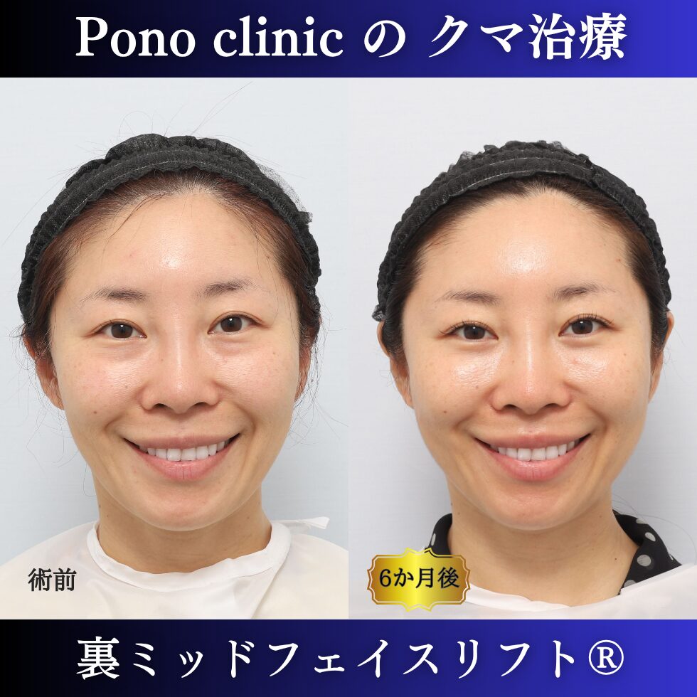目の下のクマ、クマ治療、裏ハムラ、骨膜下リフト、裏ミッドフェイスリフト、30代の症例 (5)
