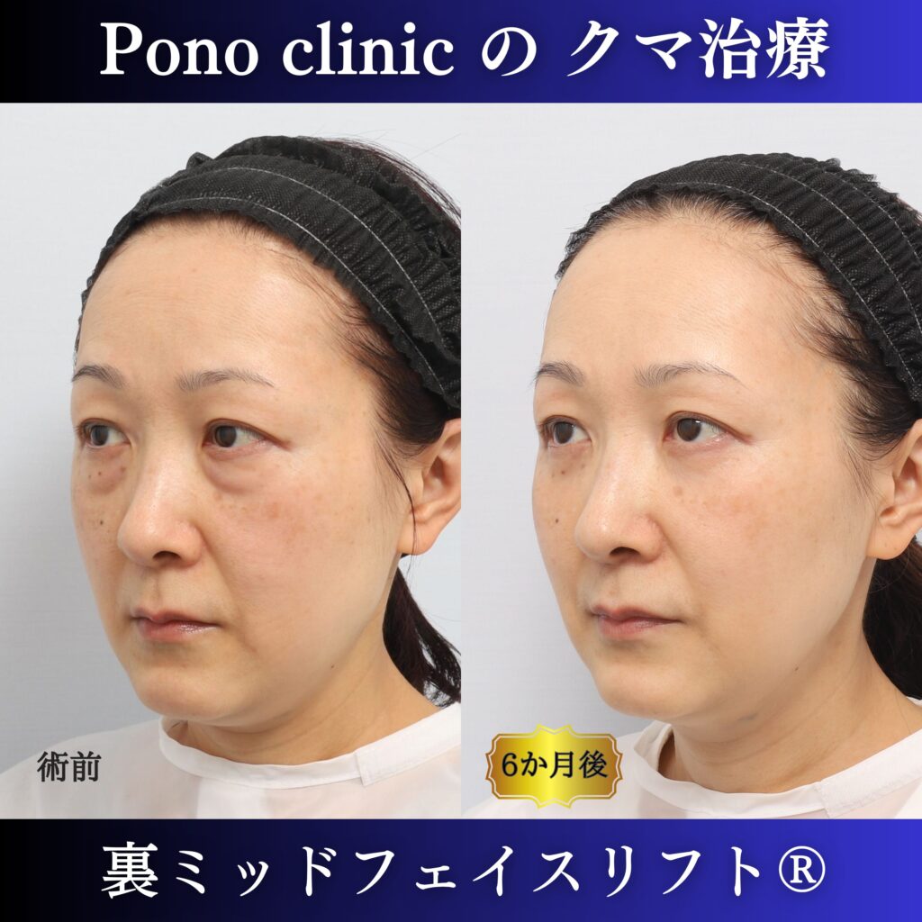 50代女性の裏ミッドフェイスリフト左斜位・術後6か月比較