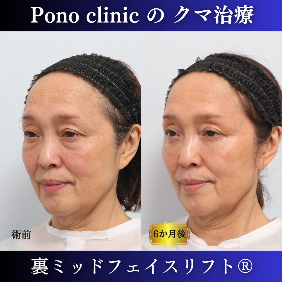 目の下のクマ、目の下のたるみ、裏ハムラ、骨膜下リフト、裏ミッドフェイスリフト、60代の症例 (3)