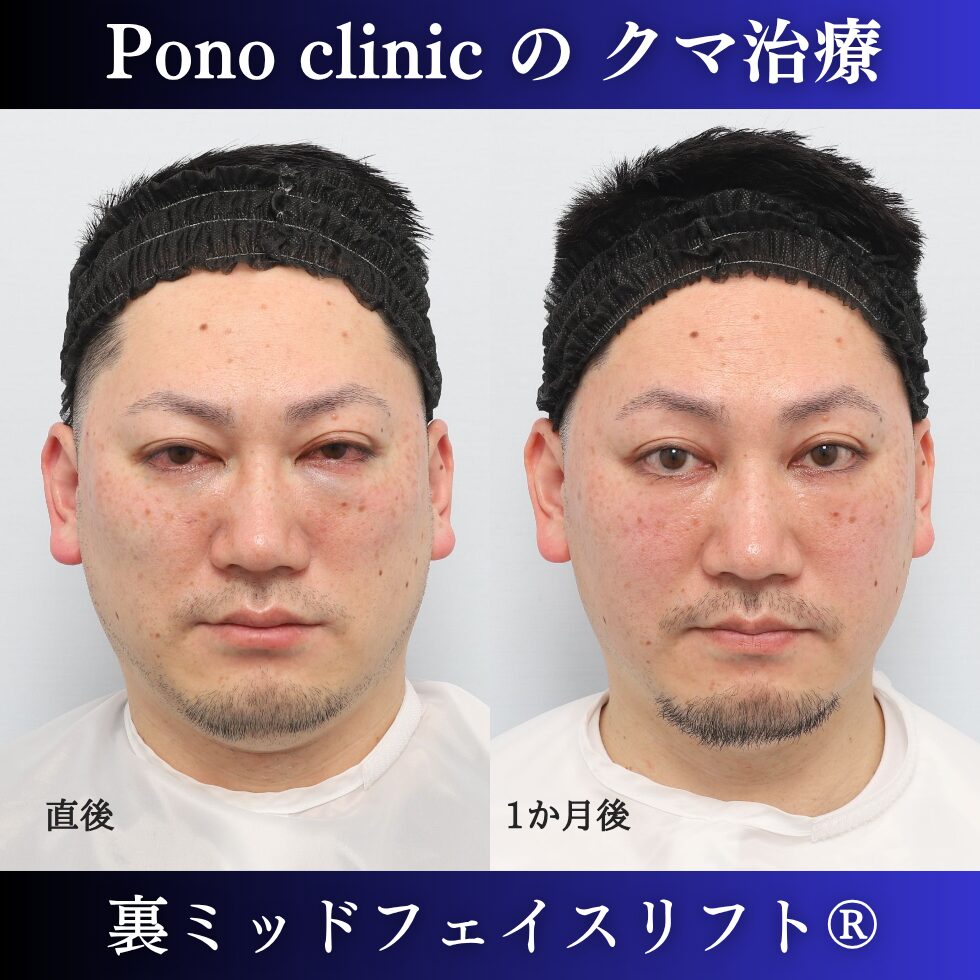 40代男性の裏ミッドフェイスリフト術直後・術後1か月の経過比較