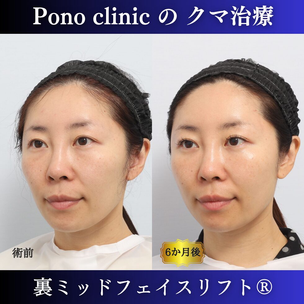 目の下のクマ、クマ治療、裏ハムラ、骨膜下リフト、裏ミッドフェイスリフト、30代の症例 (3)
