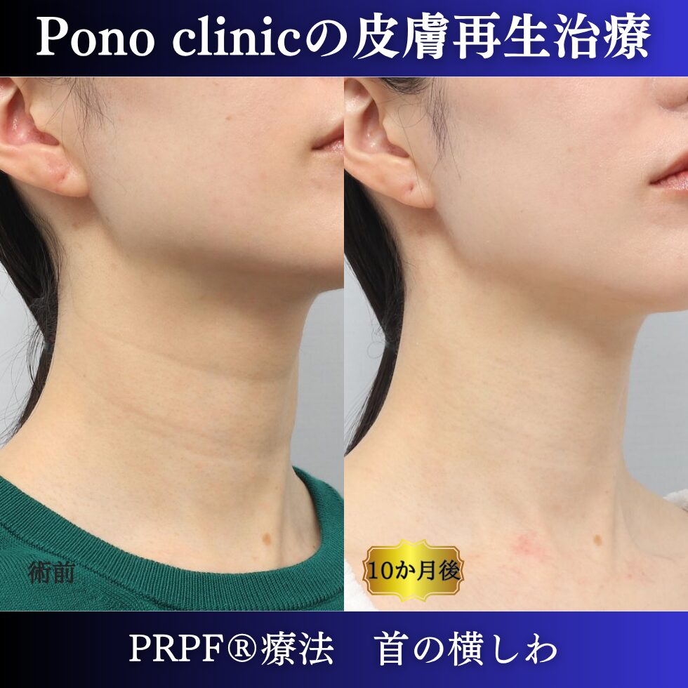 しわ治療、首のしわ、PRPF療法、30代の症例 (1)