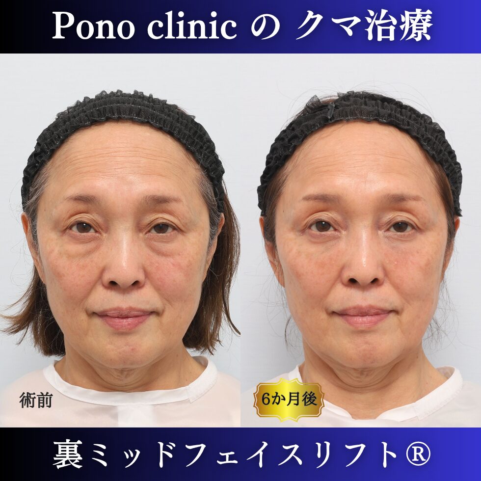 目の下のクマ、目の下のたるみ、裏ハムラ、骨膜下リフト、裏ミッドフェイスリフト、60代の症例 (5)