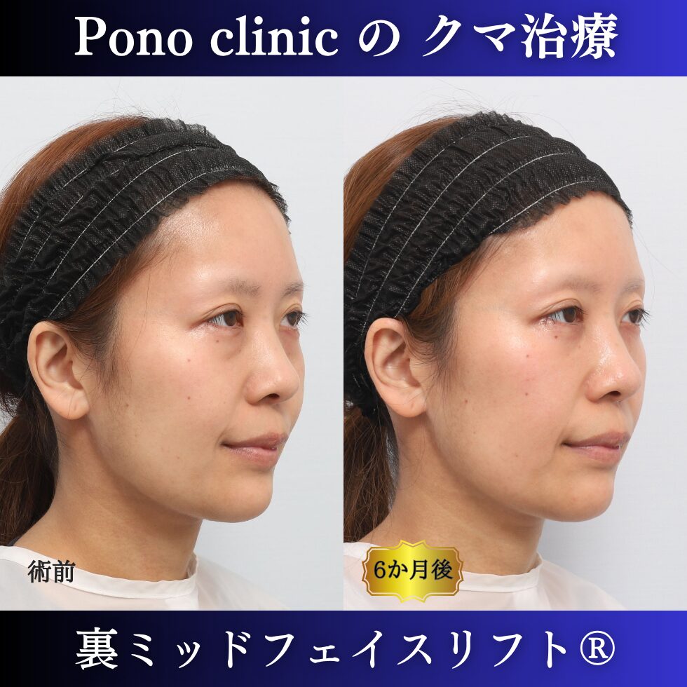 30代女性の裏ミッドフェイスリフト術前・術後の右斜位比較