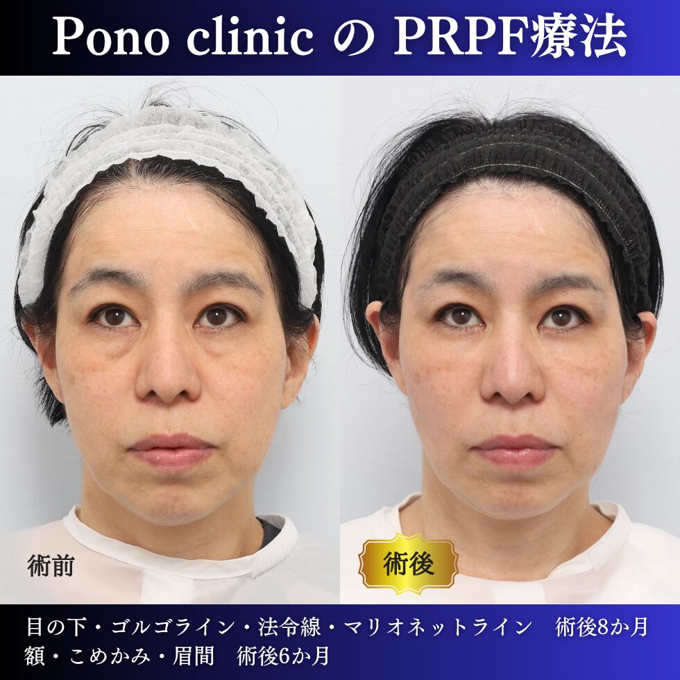 50代女性のPRPF®療法上方視・治療前治療後比較