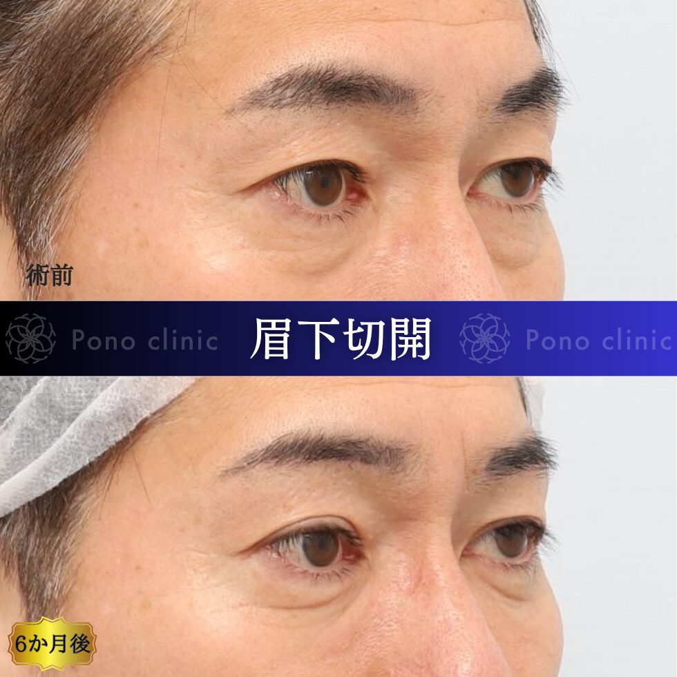眉下切開、眉下リフト、目の上のたるみ、50代男性 (1)