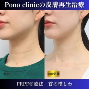 しわ治療、首のしわ、PRPF療法、30代の症例 (4)