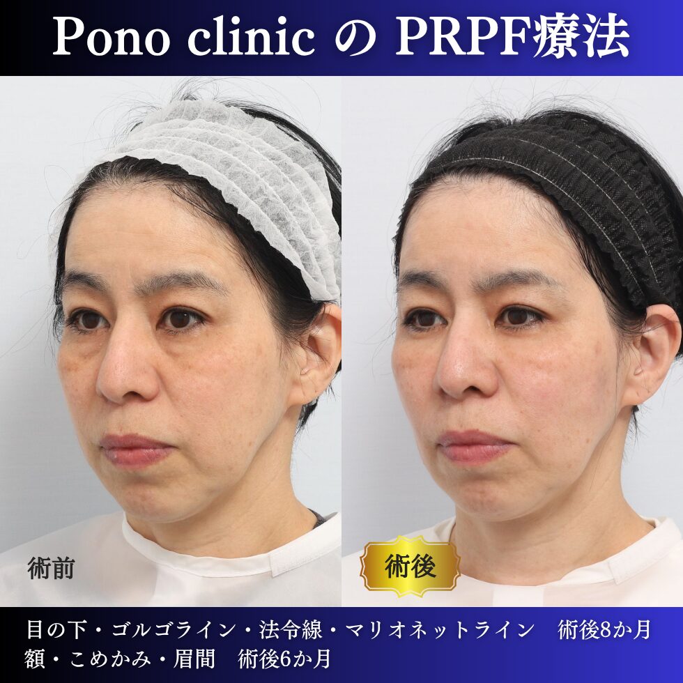 50代女性のPRPF®療法左斜位・治療前治療後比較