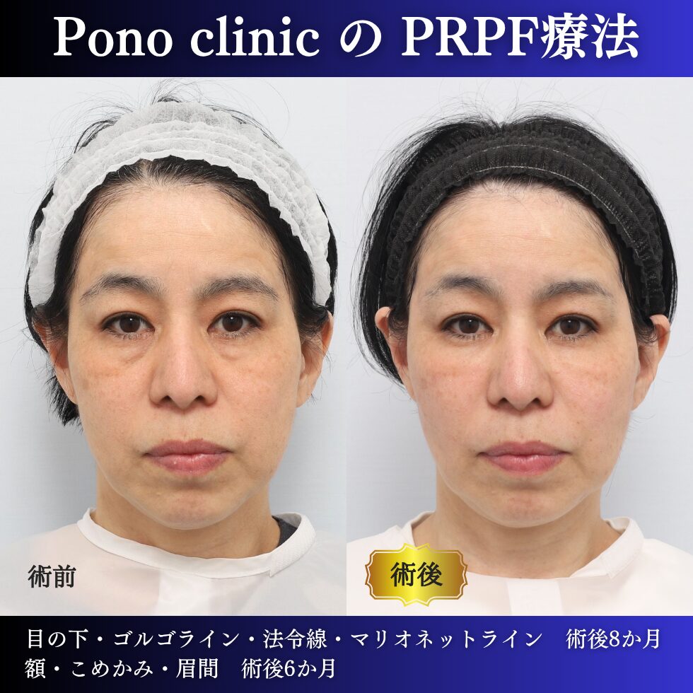 50代女性のPRPF®療法正面・治療前治療後比較