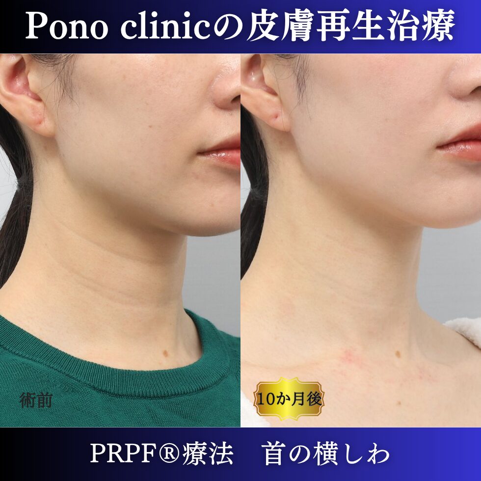 しわ治療、首のしわ、PRPF療法、30代の症例 (2)