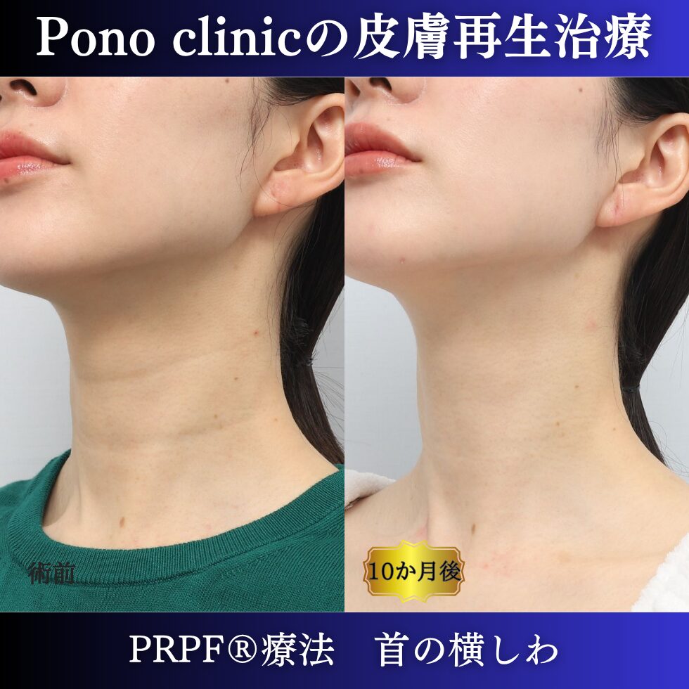 しわ治療、首のしわ、PRPF療法、30代の症例 (3)