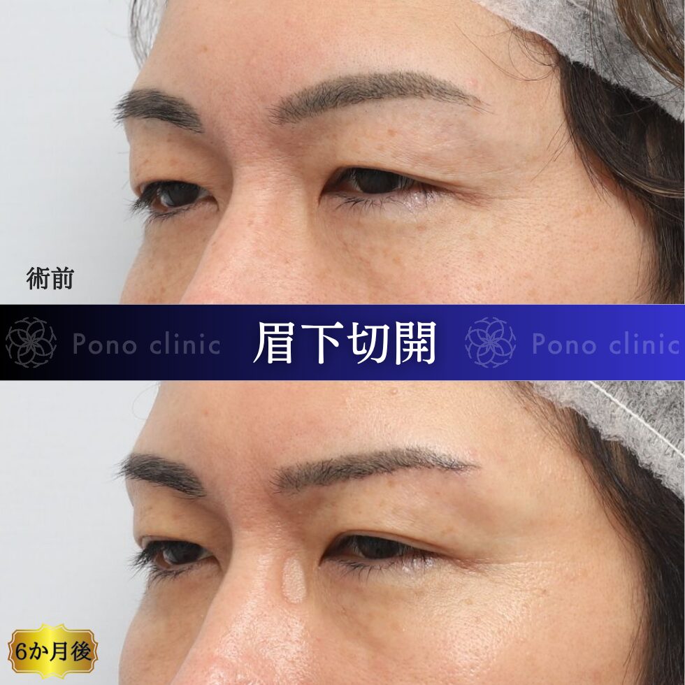 眉下切開、眉下リフト、目の上のたるみ、40代男性 (2)