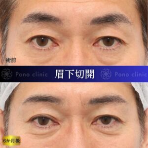 眉下切開、眉下リフト、目の上のたるみ、50代男性 (3)