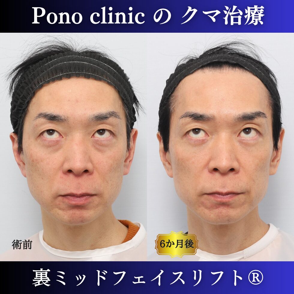 40代男性の裏ミッドフェイスリフト術前と術後6か月の上方視比較