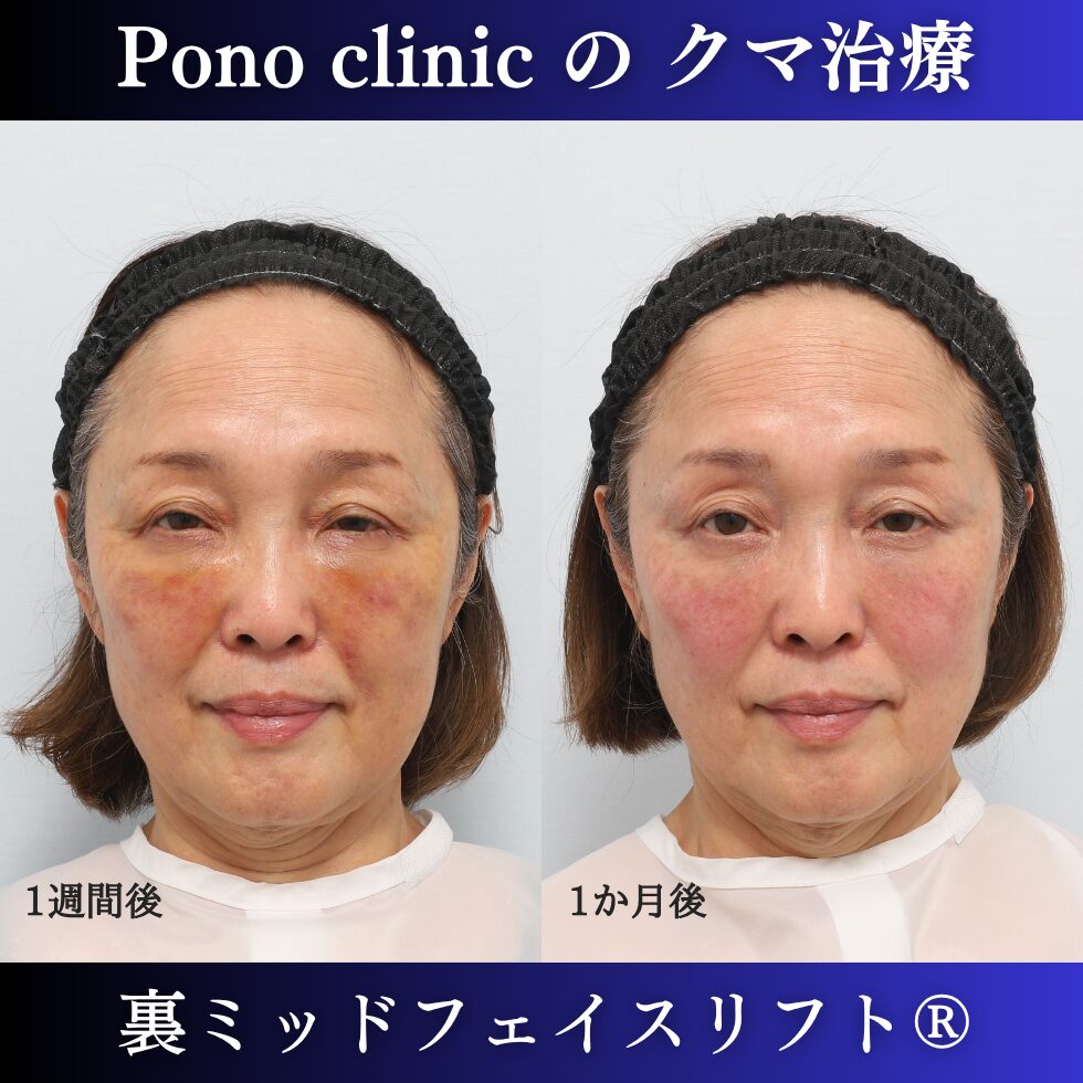 目の下のクマ、目の下のたるみ、裏ハムラ、骨膜下リフト、裏ミッドフェイスリフト、60代の症例 (1)