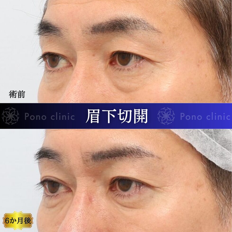 眉下切開、眉下リフト、目の上のたるみ、50代男性 (2)
